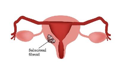 子宫腺肌瘤最新最好的治疗方法,子宫腺肌瘤最先进的治疗方案