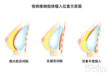 最新假体隆胸,业界领先的“前沿假体隆胸技术”。