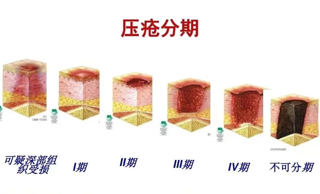 压疮的最新定义,“现代压疮定义解析”