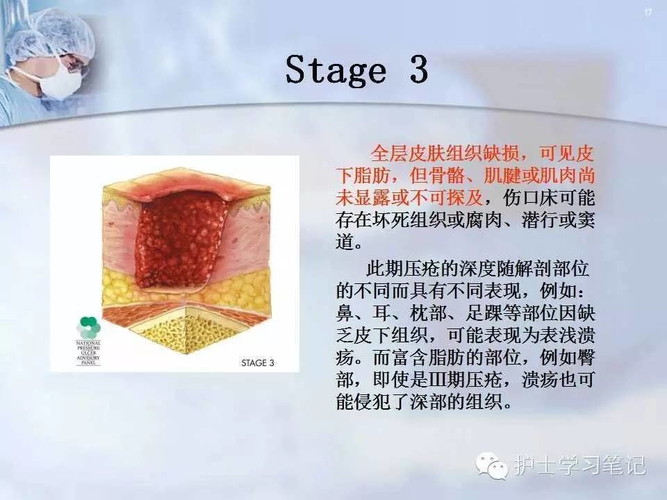 最新版压疮防治攻略：权威指南全解析